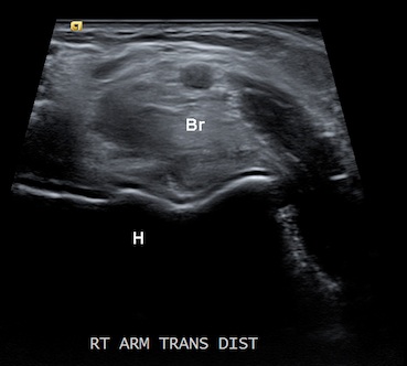 Figure 2 for case Acute rhabdomyolysis